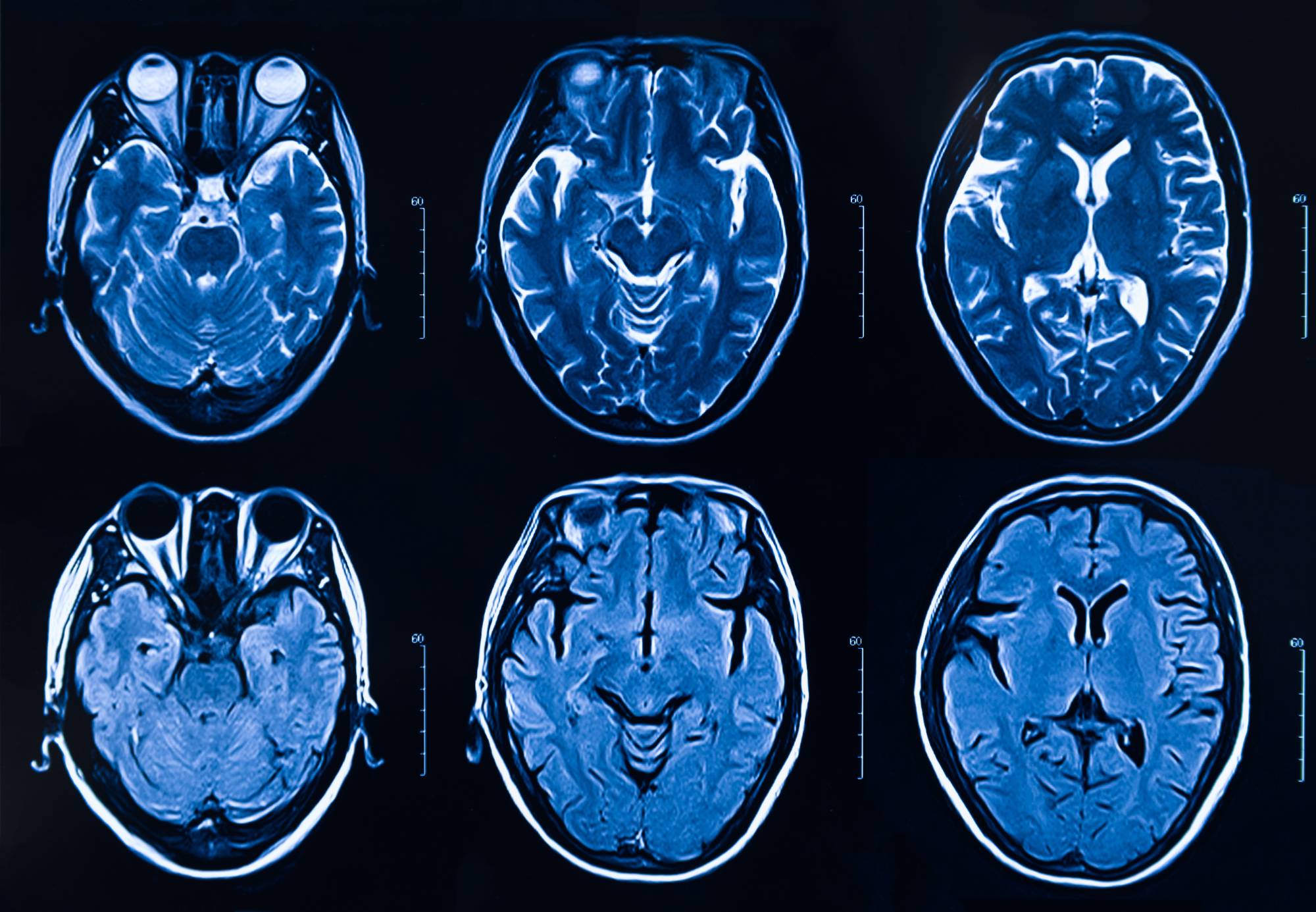 The Long-Term Effects of Surgery on the Brain