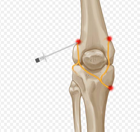 Genicular Nerve Block