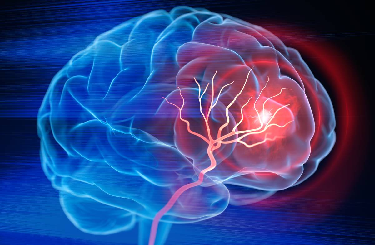 Risk of Stroke After Surgery 