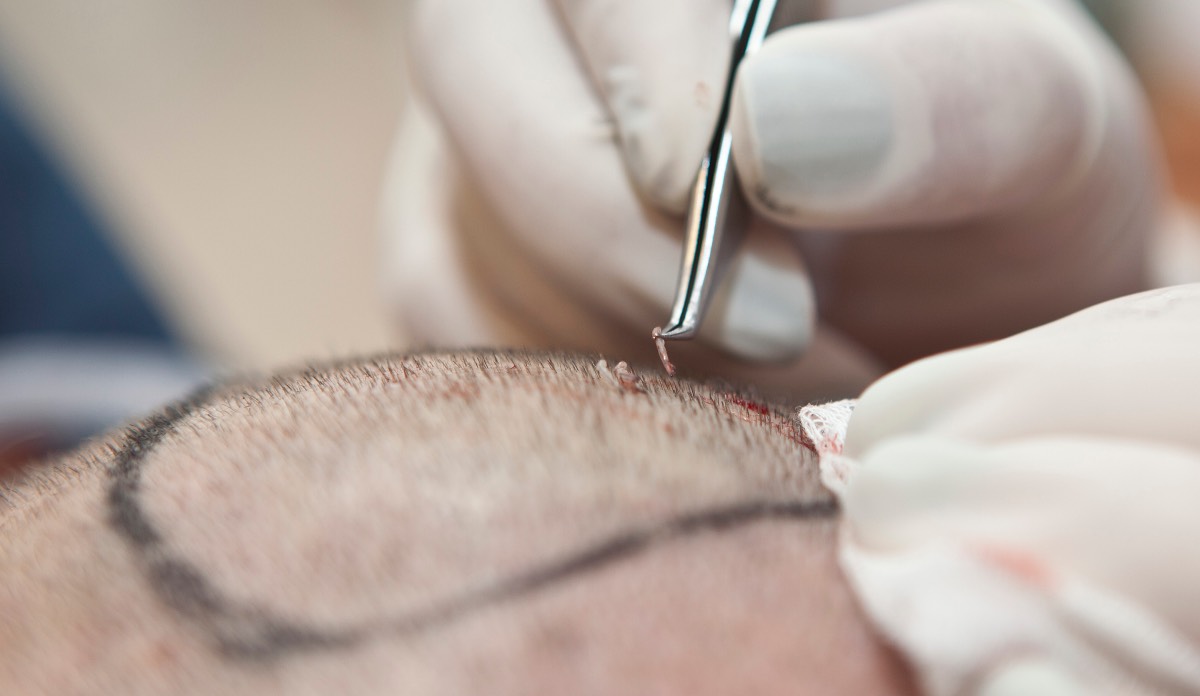 Anesthesia Care for Hair Transplant